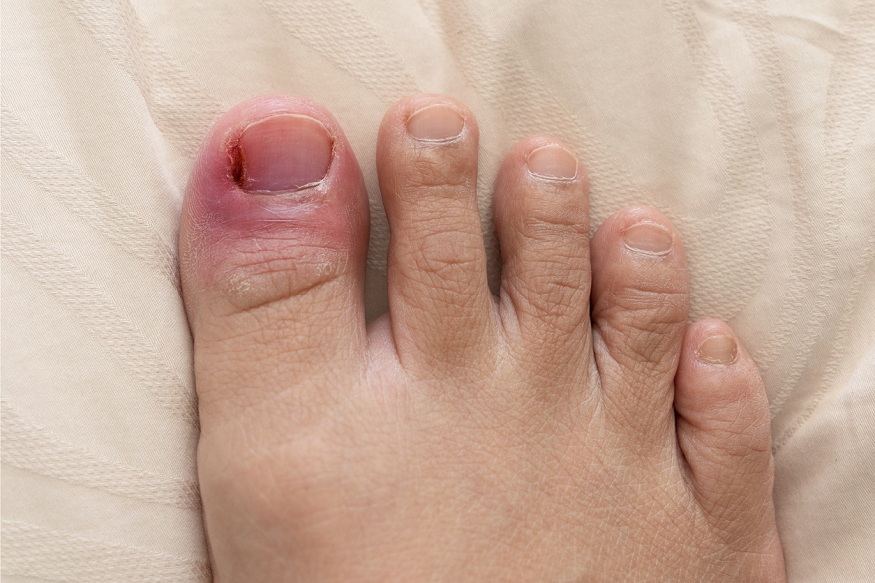 A Guide on Ingrown toenails